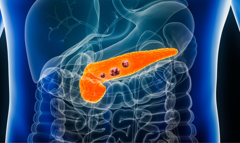 Cáncer de páncreas: lo que debe saber